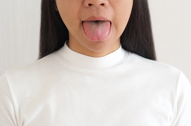 Dry Mouth and Oral Thrush: Understanding the Connection
