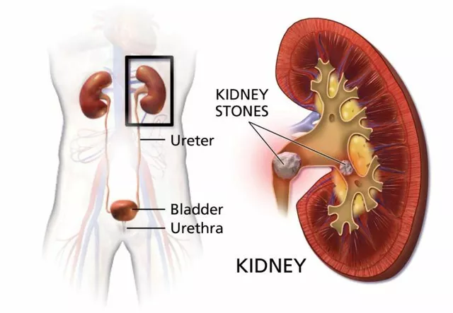 How to Pass a Kidney Stone: Tips and Tricks for a Smooth Experience